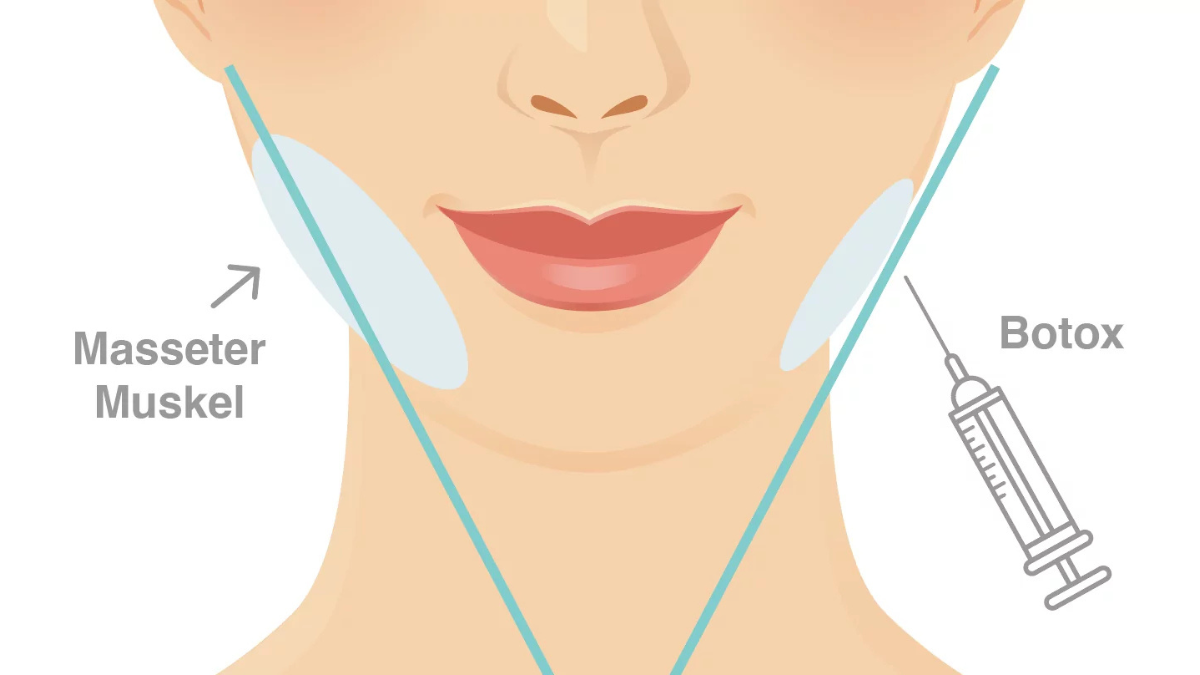 masseter botox vorher nachher